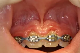 Frenectomy