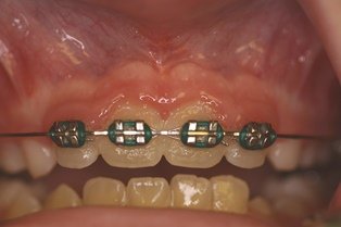 Frenectomy